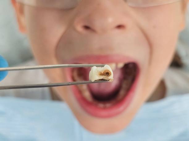 Best Emergency Dental Care for Abscessed Tooth in Thompsons Station, TN
